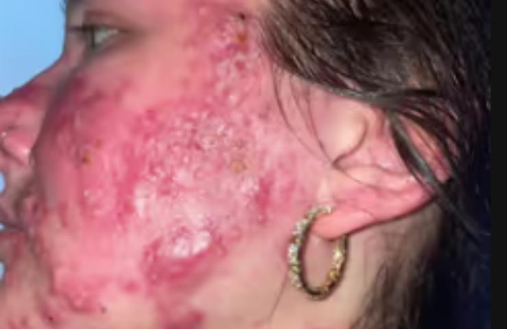 Courtney Leigh cura per l'acne 
